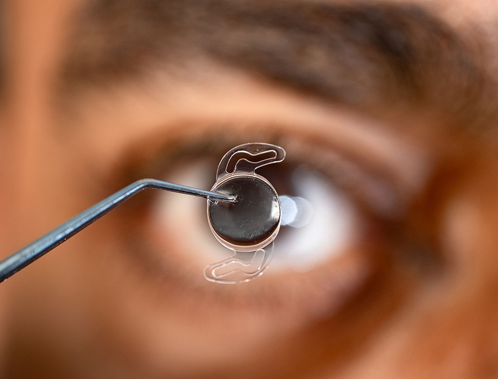 Cataract