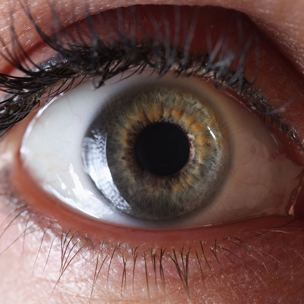 Hoornvlies (cornea) - Fuchs endotheel dystrofie
