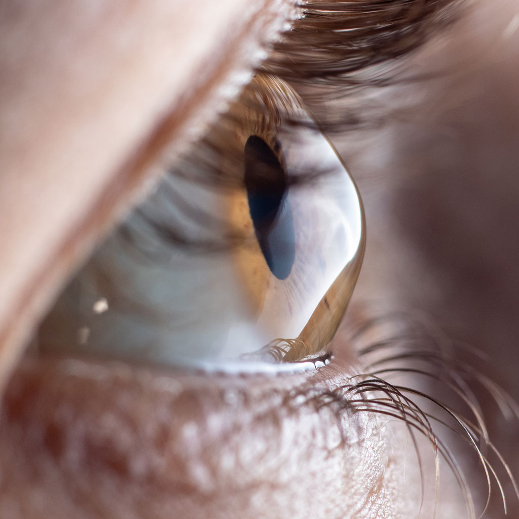 Hoornvlies (cornea) - Keratoconus
