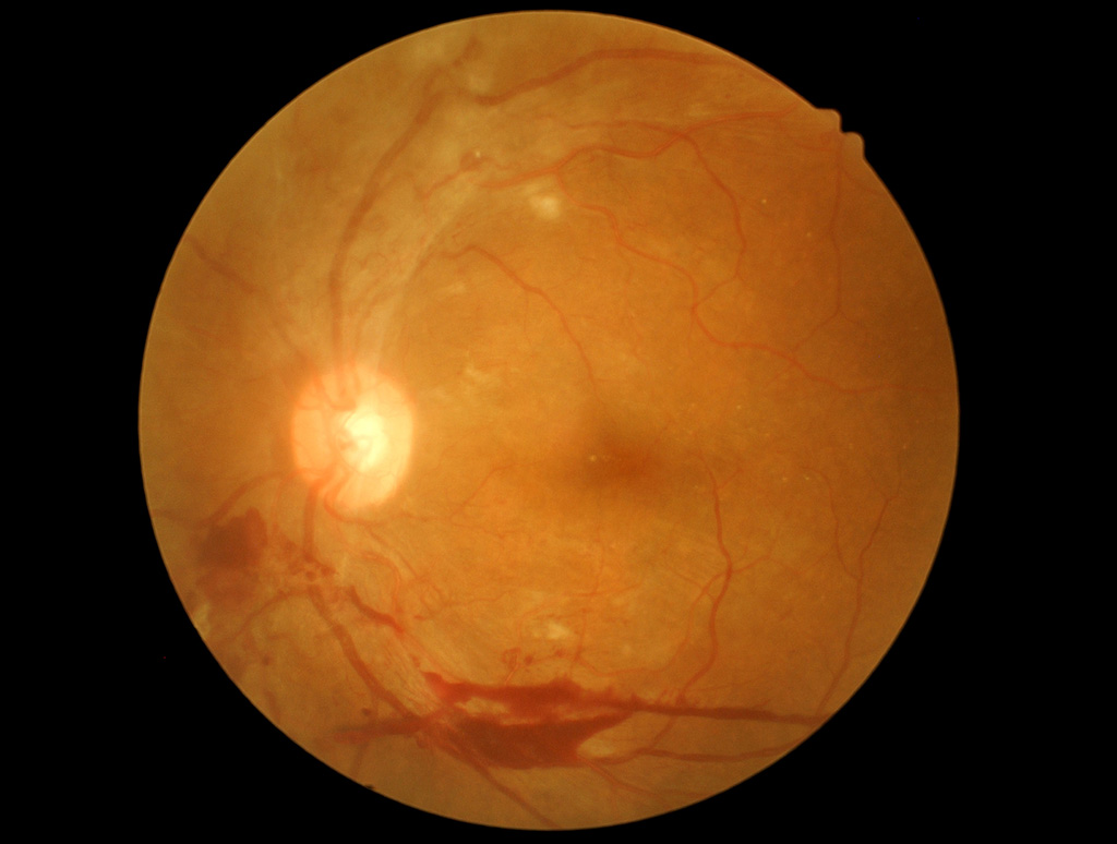 Retinale veneuze occlusie (RVO)